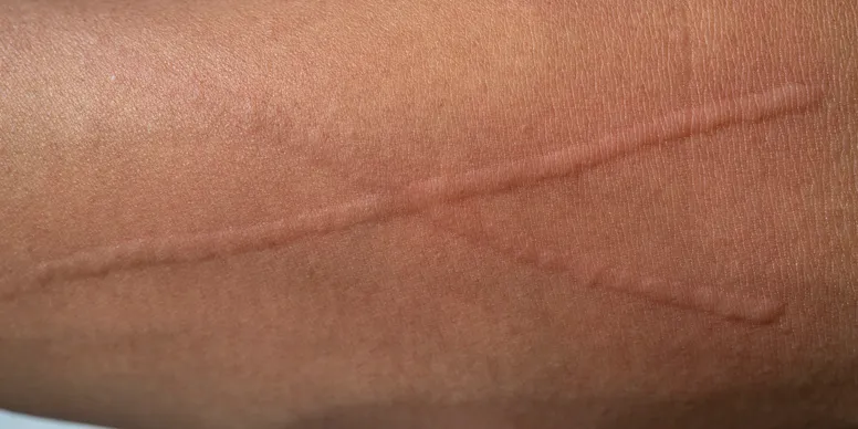 Close-up of a skin scar with a crisscross pattern.